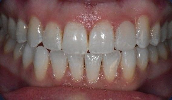 After Invisalign braces