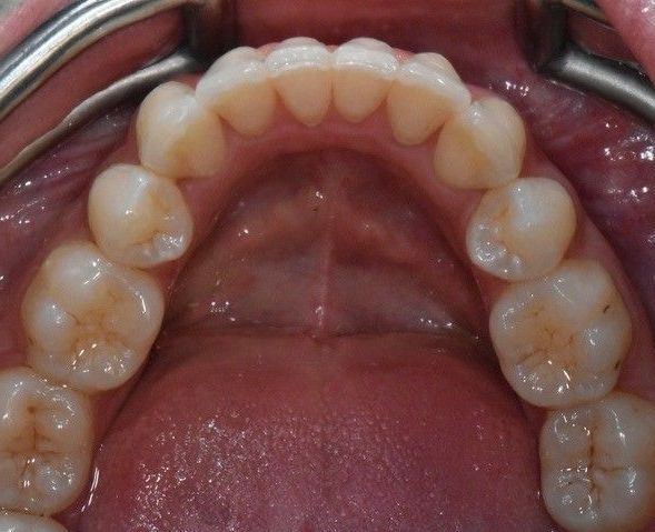 After Invisalign braces