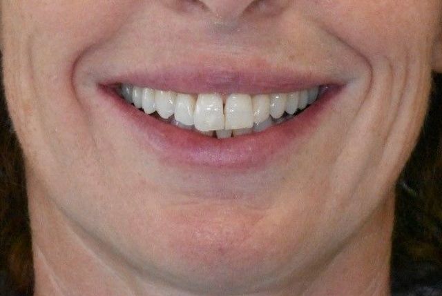 After Invisalign braces