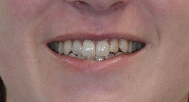 Before Invisalign braces