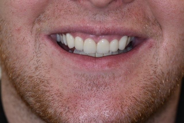After teeth whitening treatment
