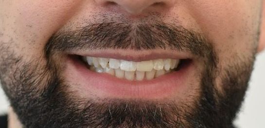 After Invisalign braces