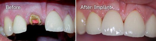 teeth before and after 2