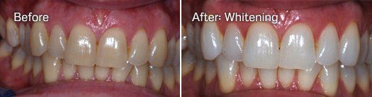 teeth before and after