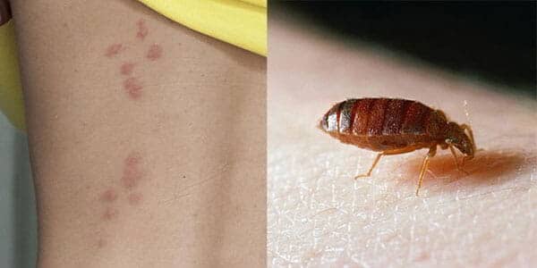 CASA JARDÍN INDUSTRIA - Ronchas causadas por chinches CASA JARDÍN INDUSTRIA - Ronchas causadas por chinches