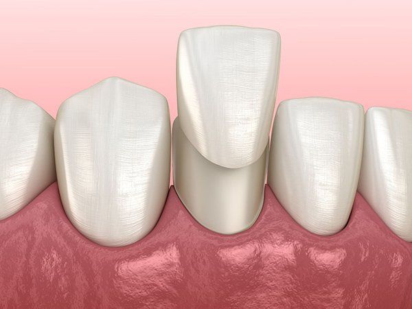 Porcelain Bonded Veneers