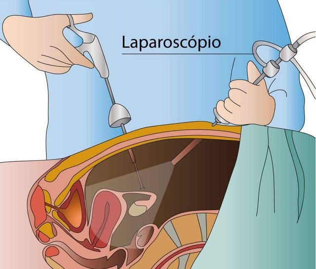 Menstruação com coágulos e endometriose: explorando a conexão