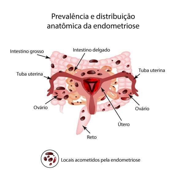Endometriose e menstruação