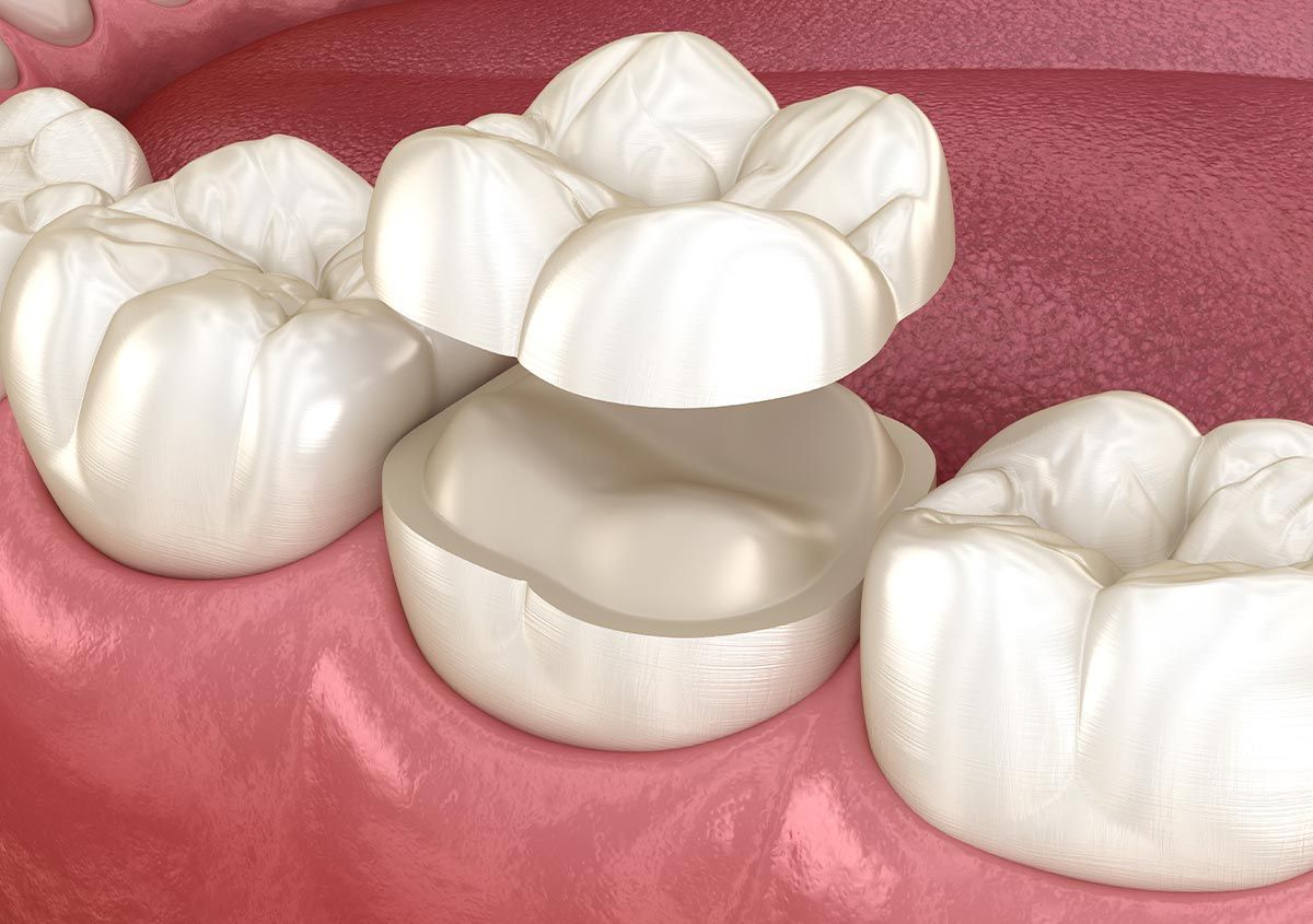 Do dental crowns look natural, and many other questions about this restoration