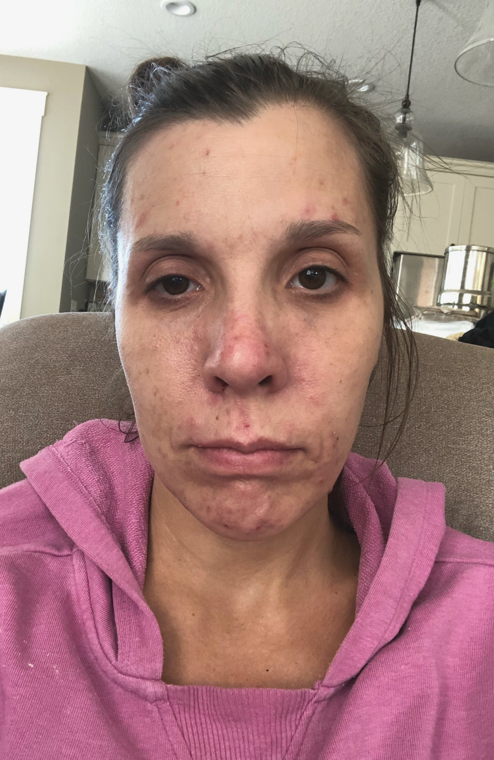 Amy sitting in recliner no expression bells palsy face and covered in Babesia marks on her face very sick