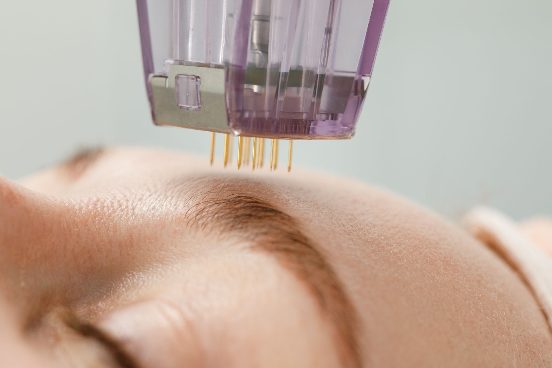 Microneedling device touching a forehead during a skin treatment
