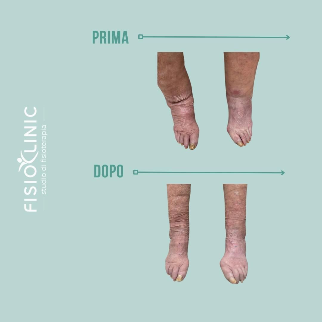 Gambe prima/dopo il trattamento. In alto: gambe gonfie. In basso: gambe migliorate.
