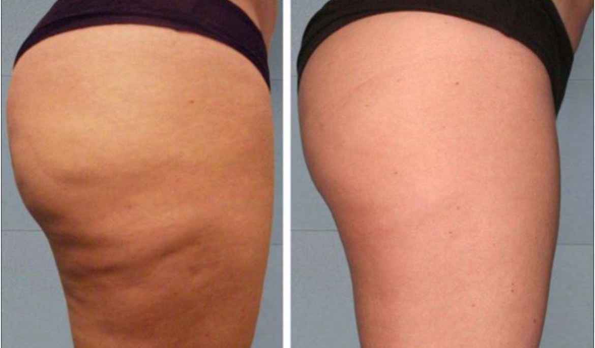 Prima e dopo di una coscia. A sinistra si nota la cellulite. A destra la pelle è liscia.