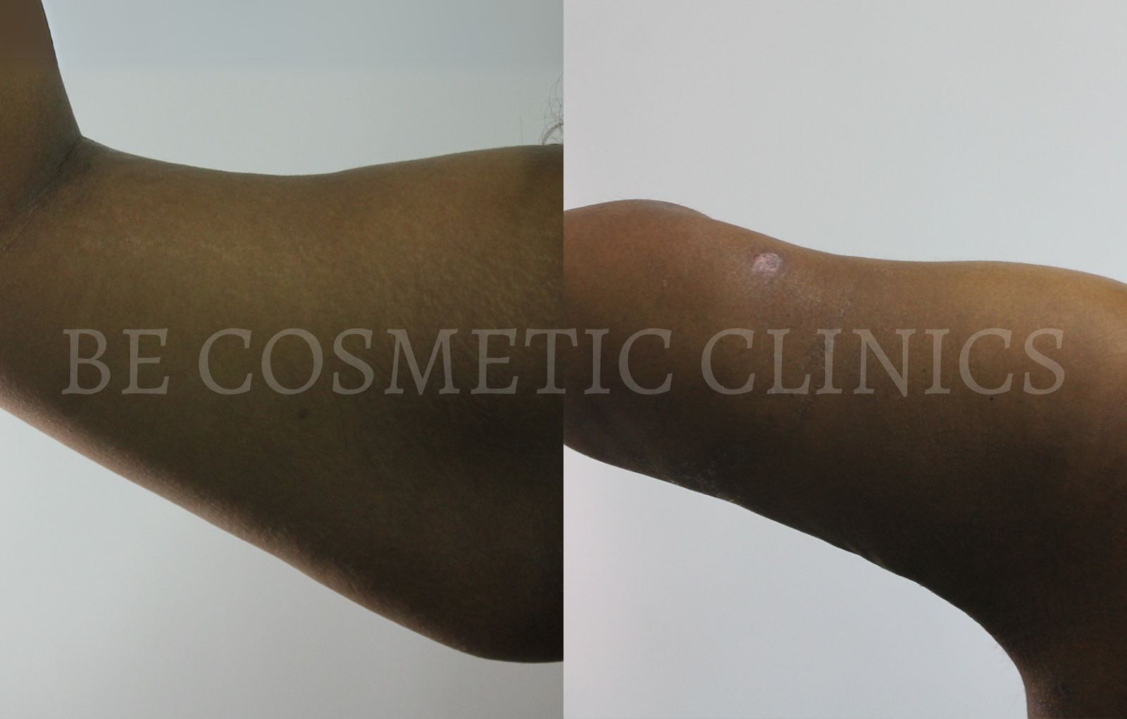 Be Cosmetic Clinics Arm VASER Liposuction results
