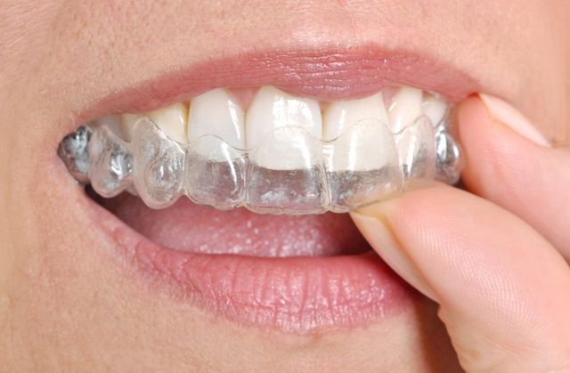 how an Invisalign treatment plan is made