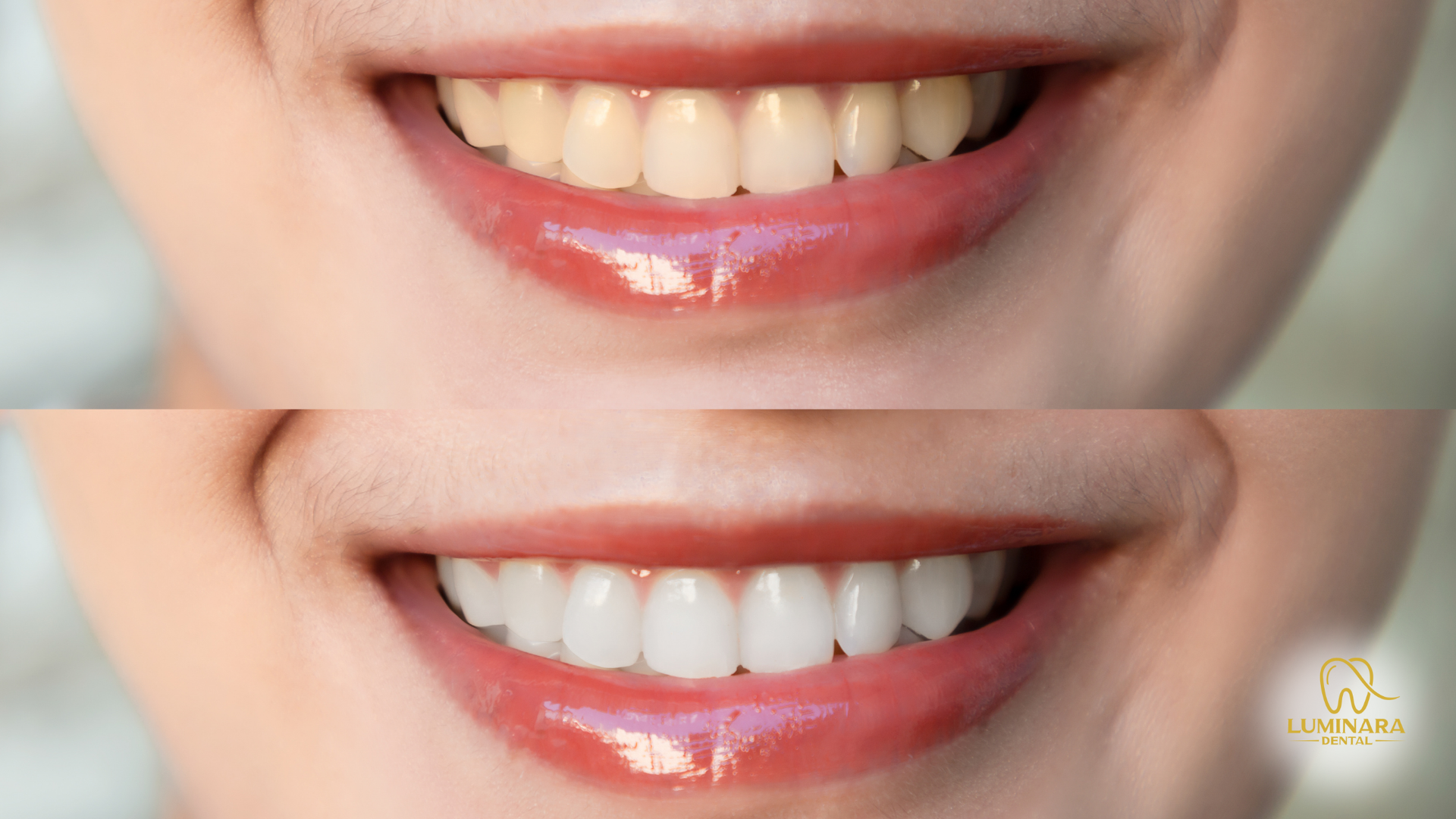 A before and after picture of a woman 's teeth.