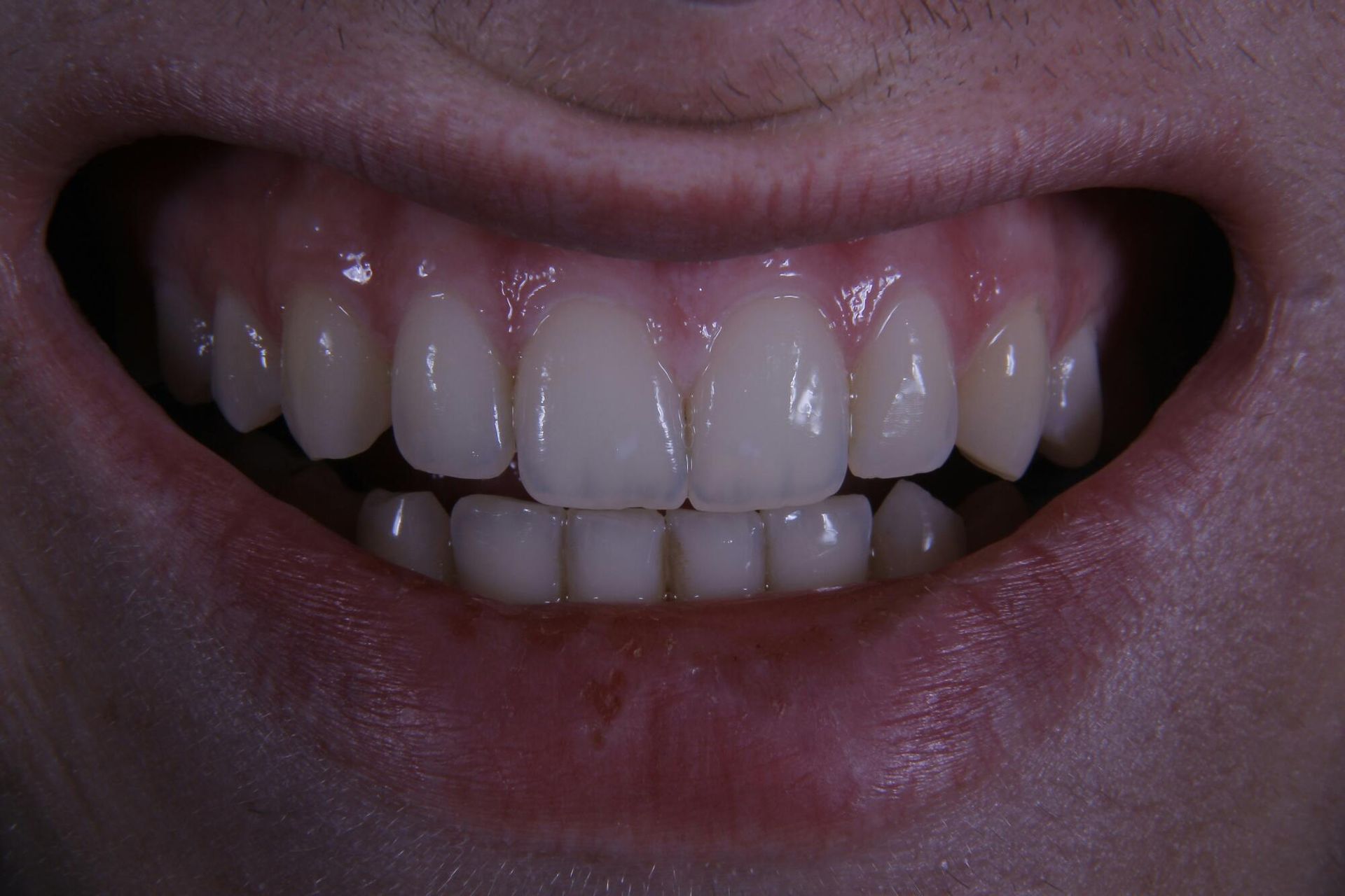 A close-up view of a person’s mouth showing straight, clean, white teeth while smiling.