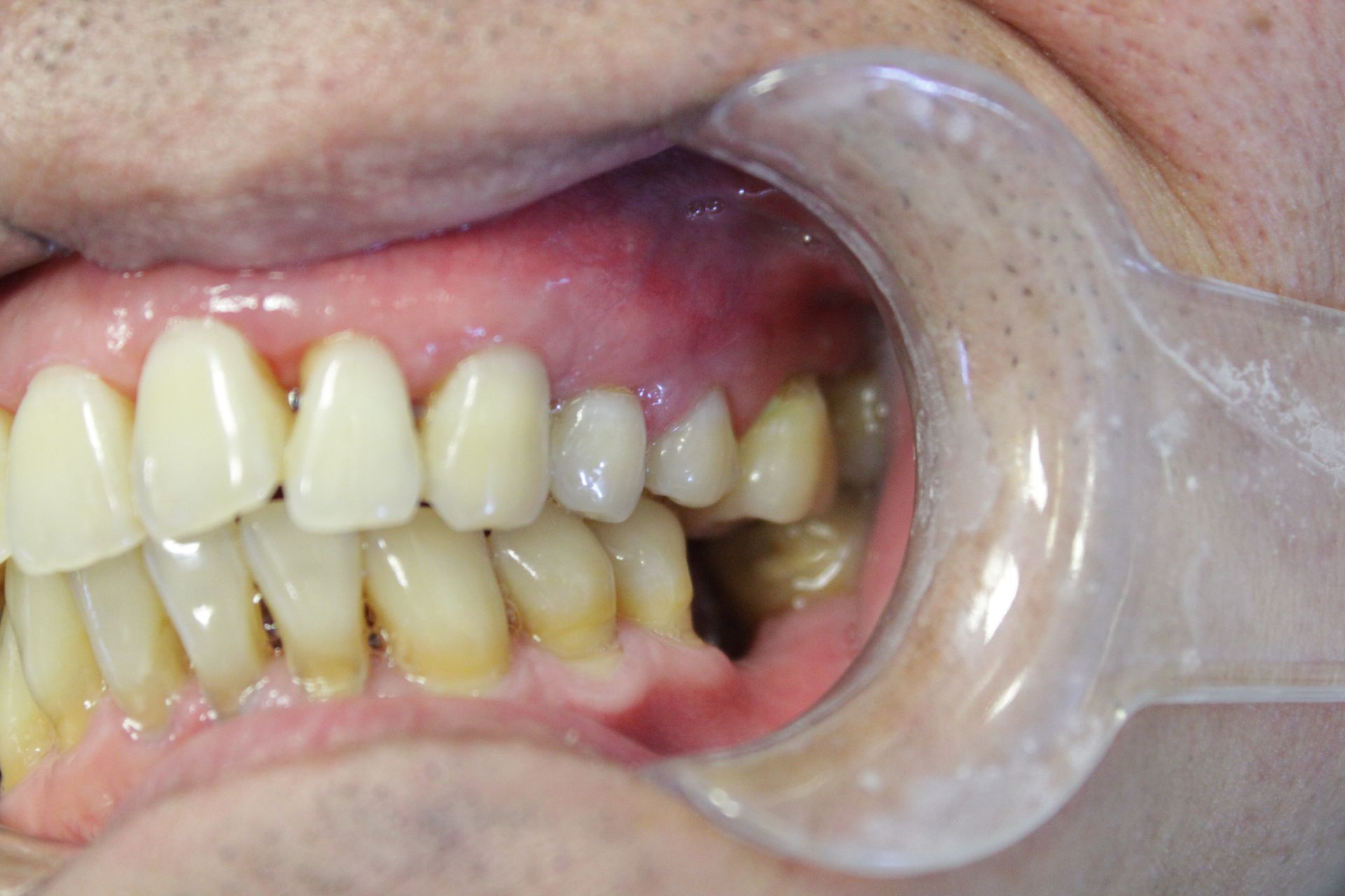 A close up of a person 's teeth with a mouth guard.