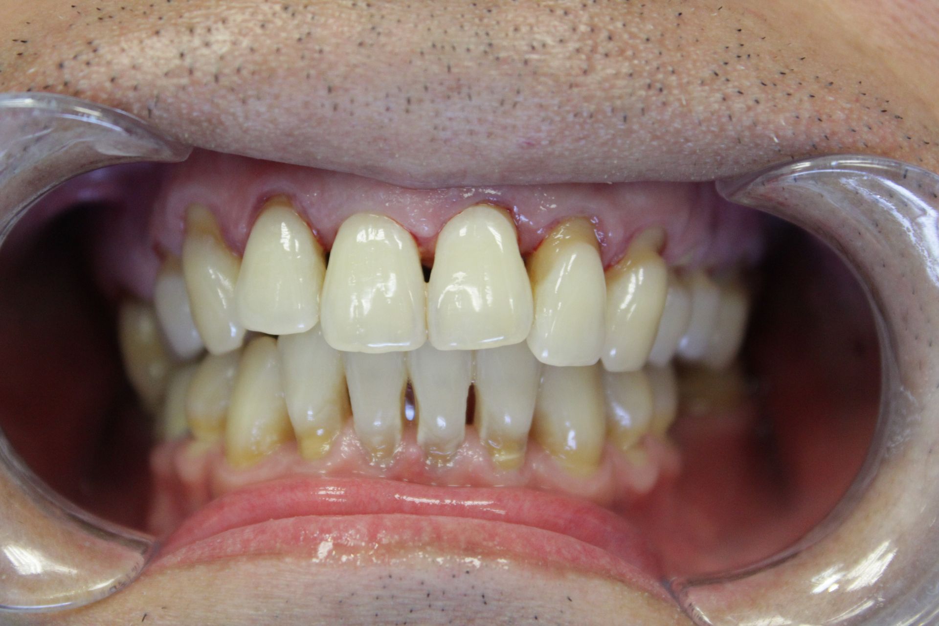 A close up of a person 's teeth with a mouth guard.