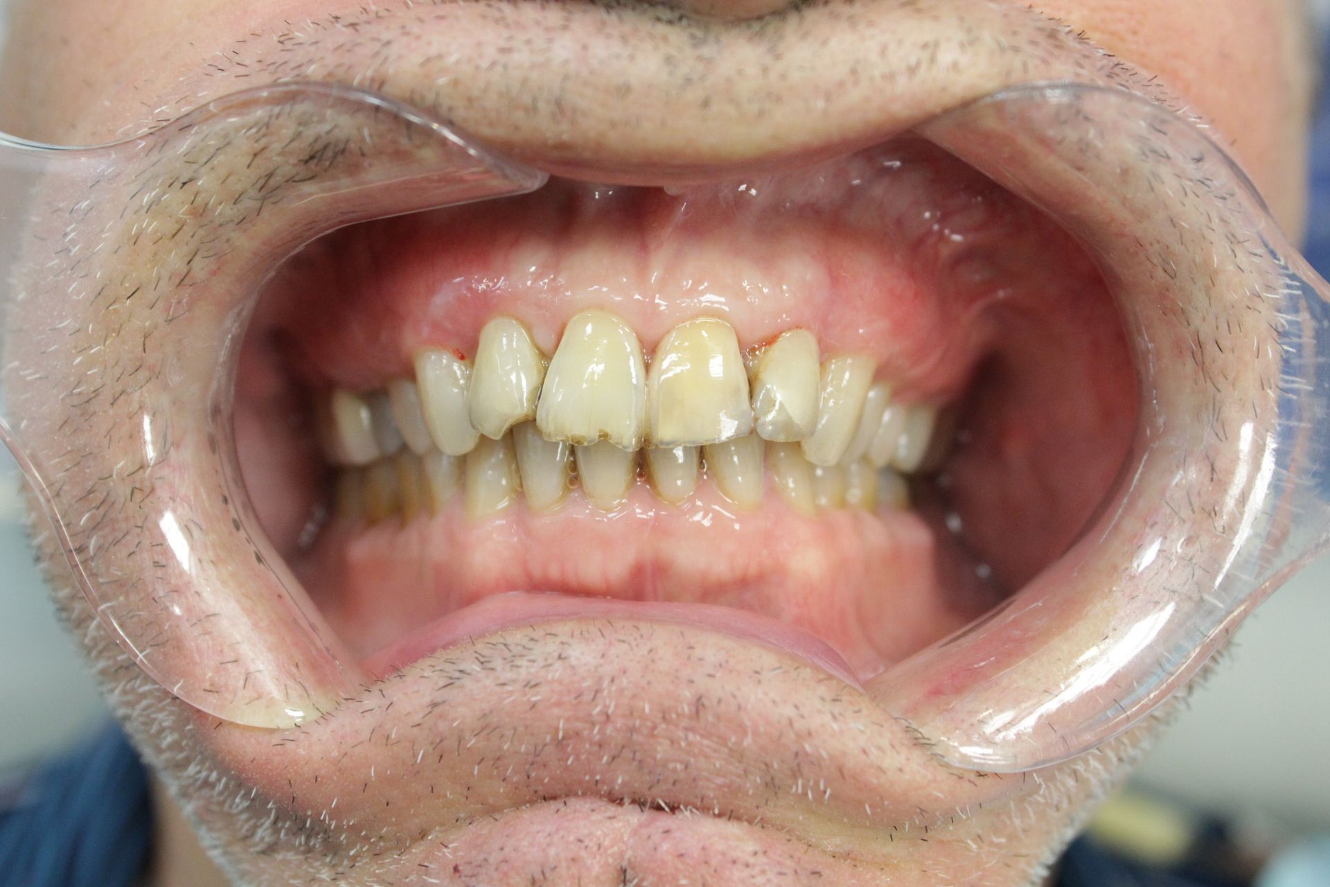 A close up of a man 's mouth with a plastic mouth guard.