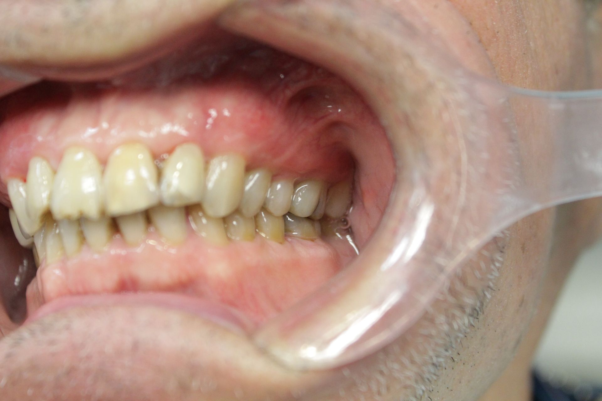 A close up of a man 's mouth with a plastic mouth guard.