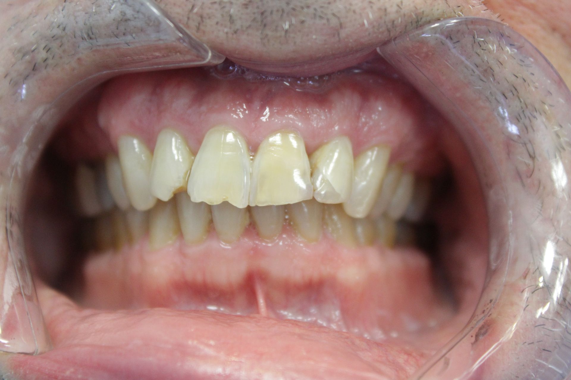 A close up of a person 's teeth with a clear mouth guard.