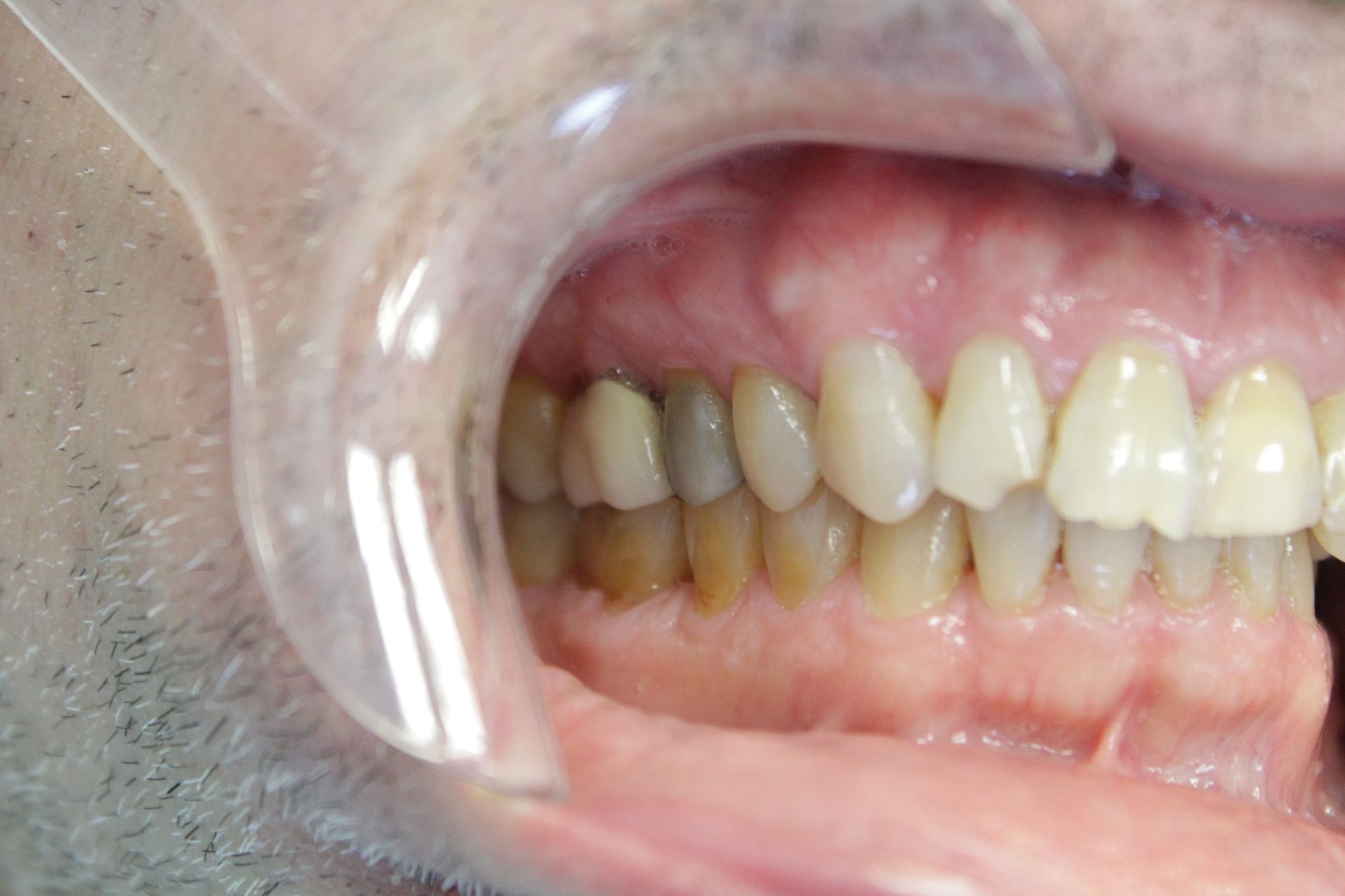A close up of a person 's teeth with a plastic mouth guard.