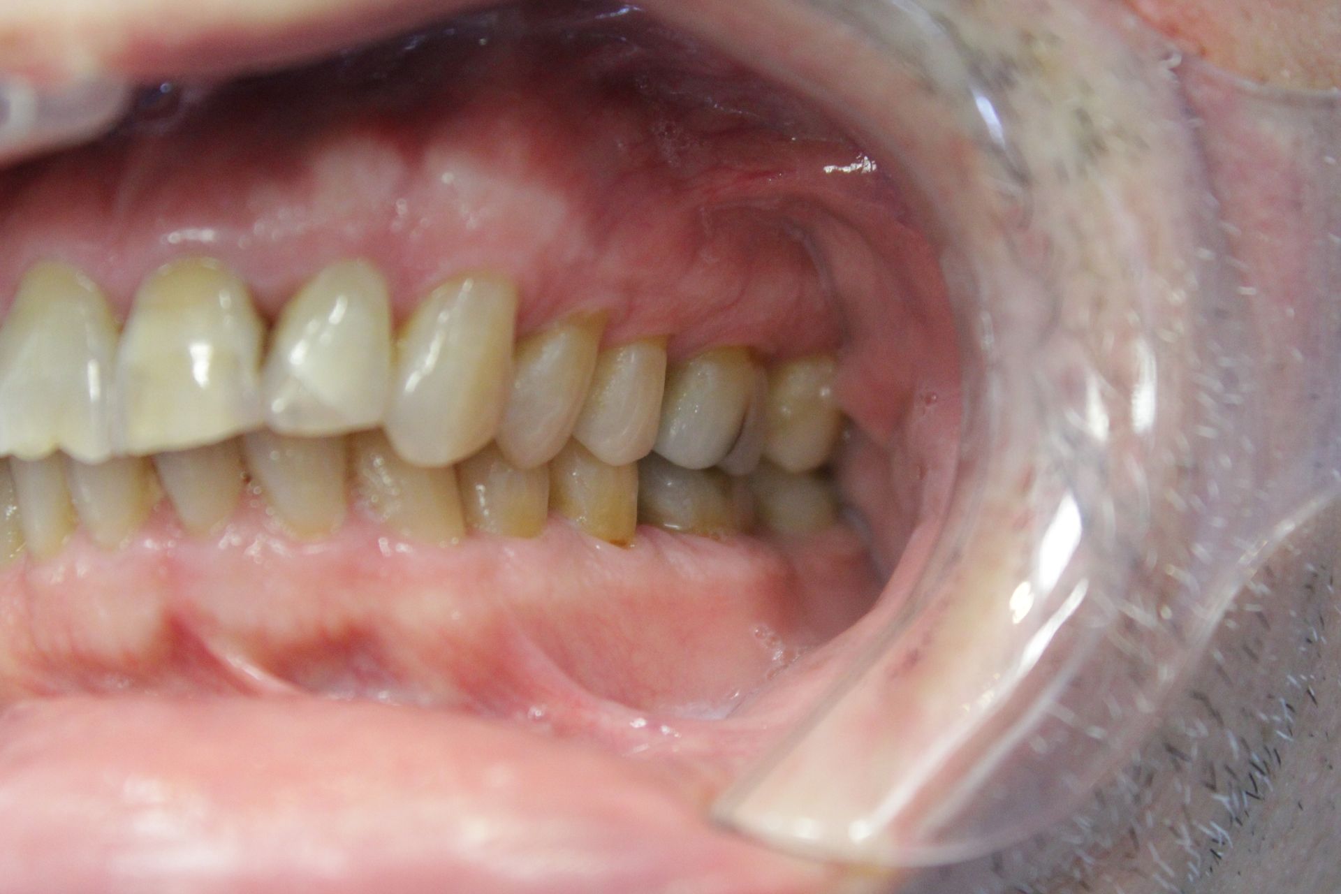 A close up of a person 's mouth with their teeth showing.