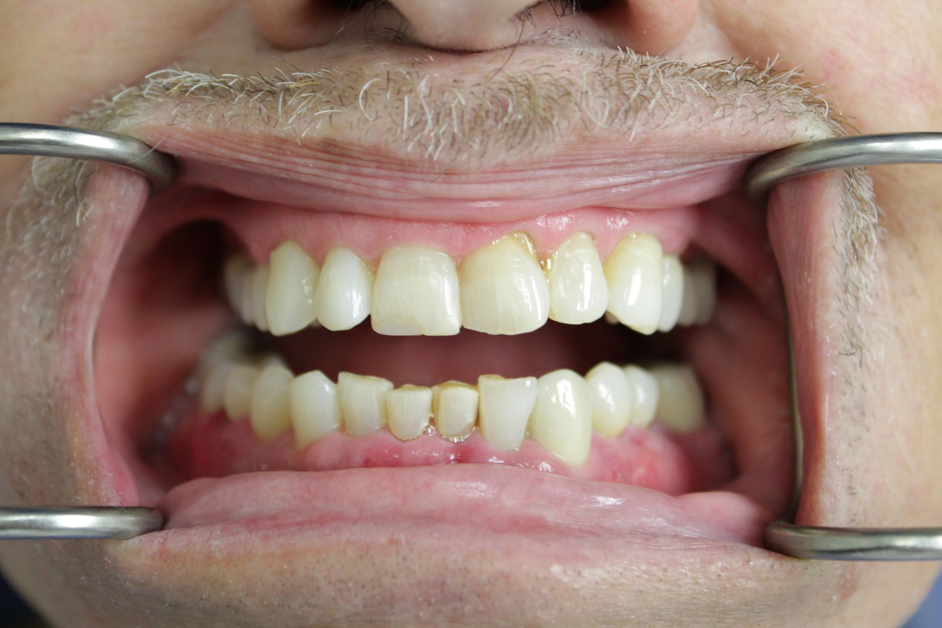 A close up of a man 's mouth with braces on his teeth.