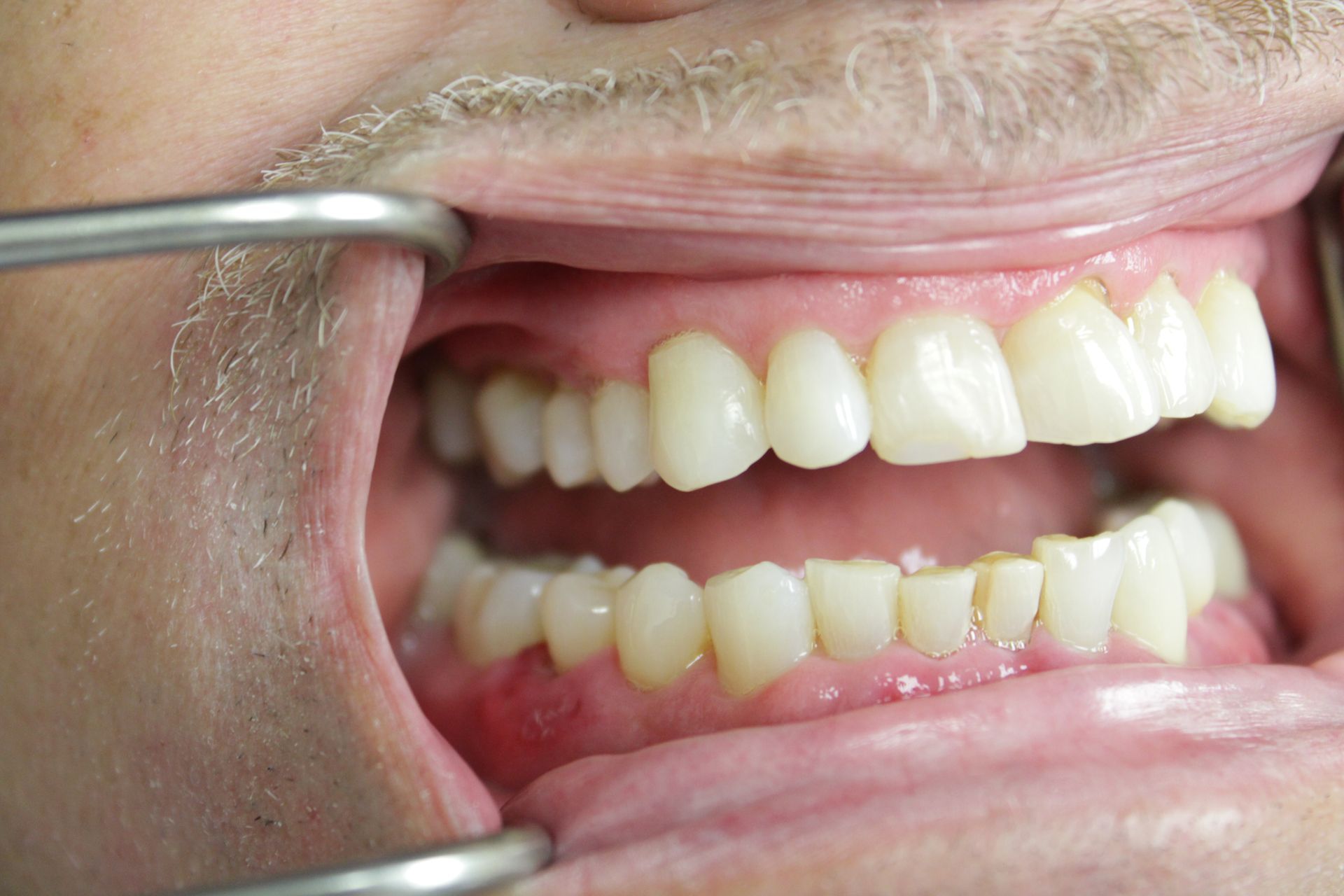 A close up of a person 's mouth with a dental mirror.