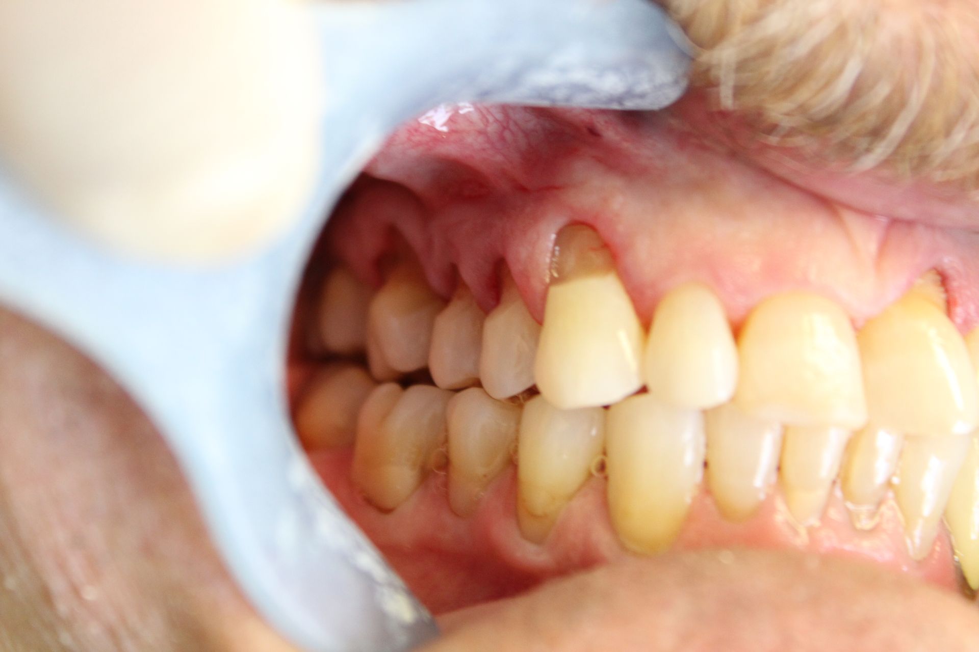 A close up of a person 's teeth with a dental mirror.
