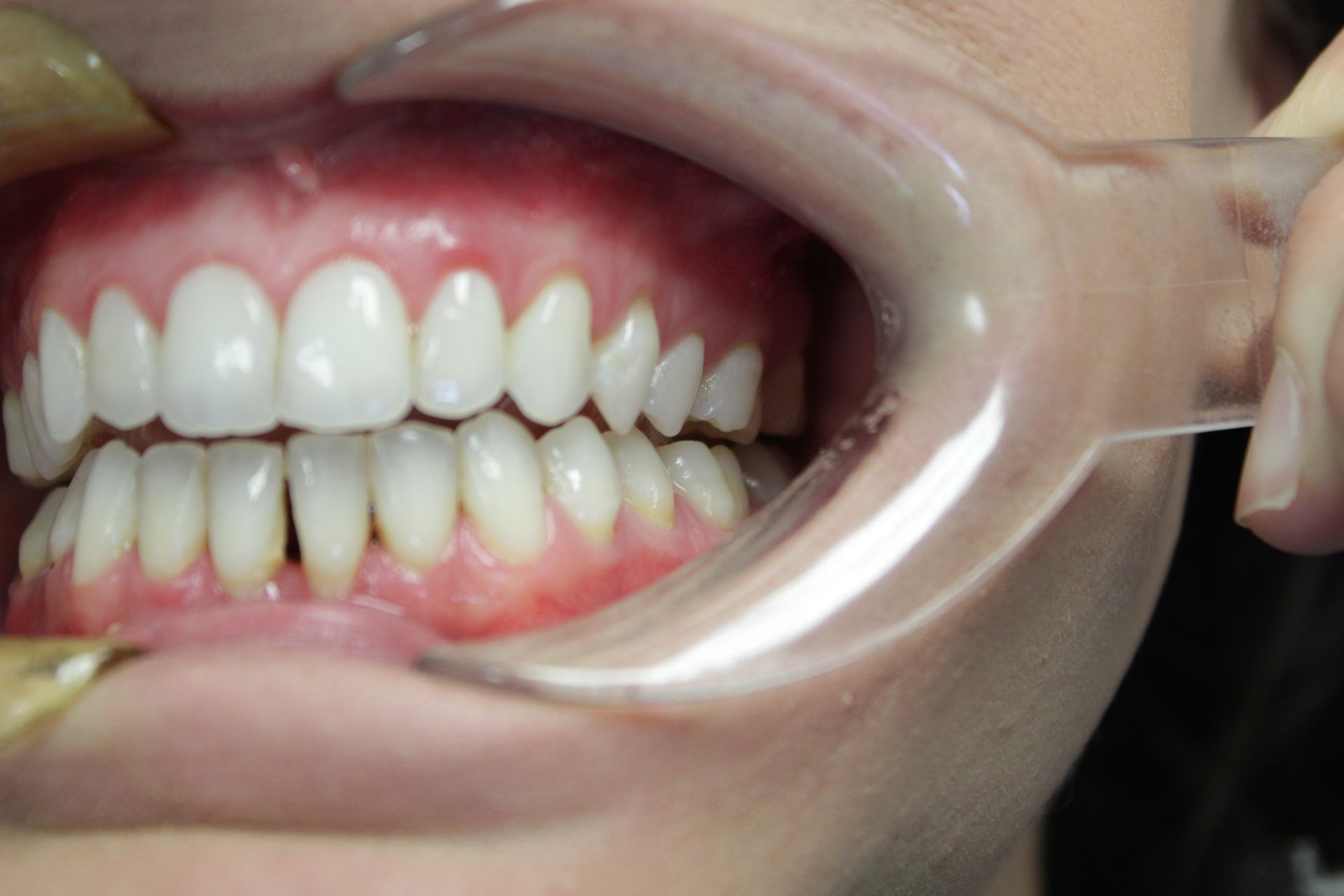 A close up of a person 's teeth with a mouth guard.