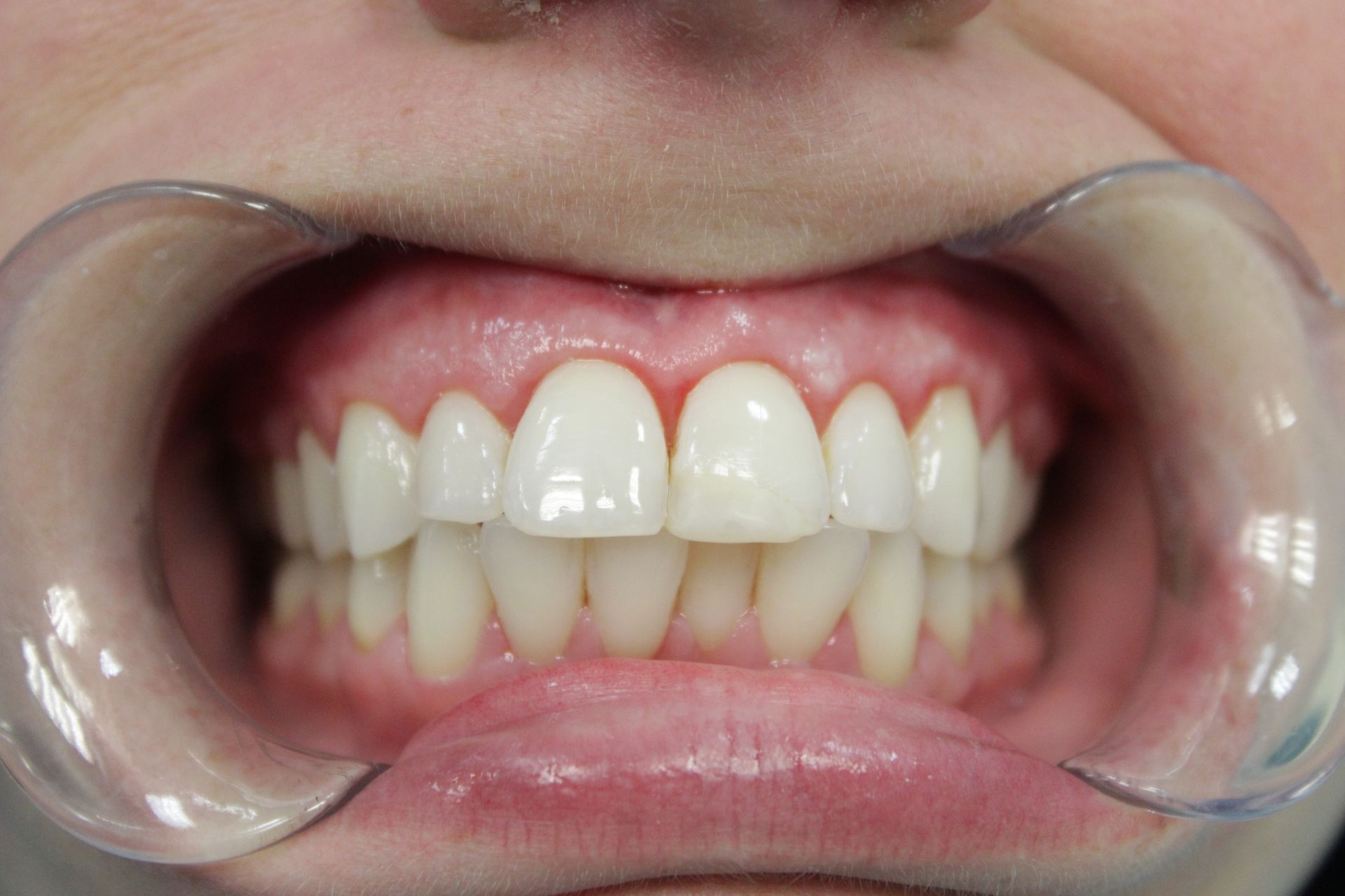 A close up of a person 's teeth with a mouth guard.