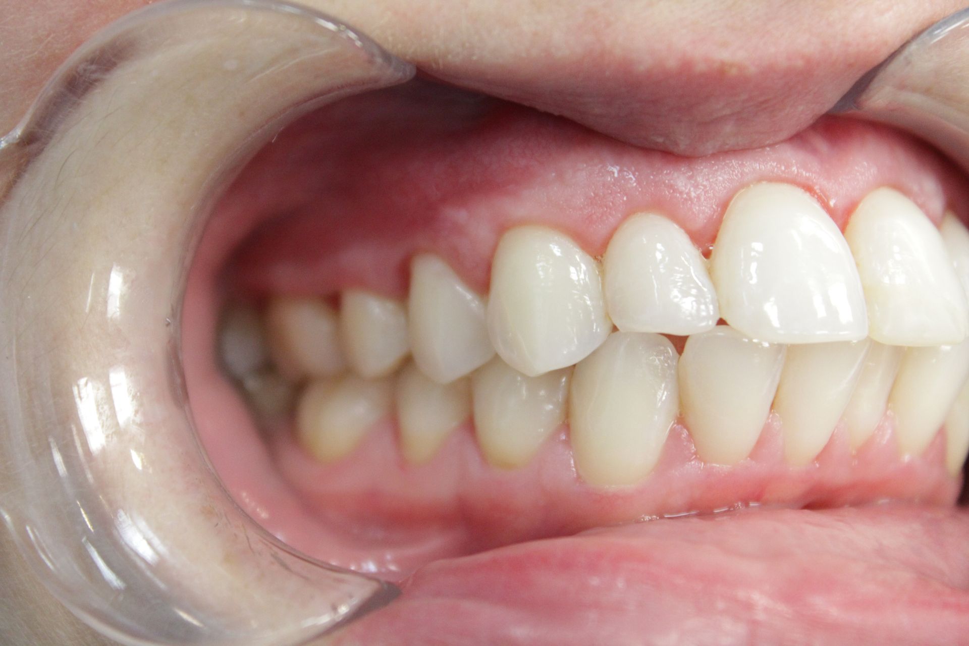 A close up of a person 's teeth with a mouth guard.