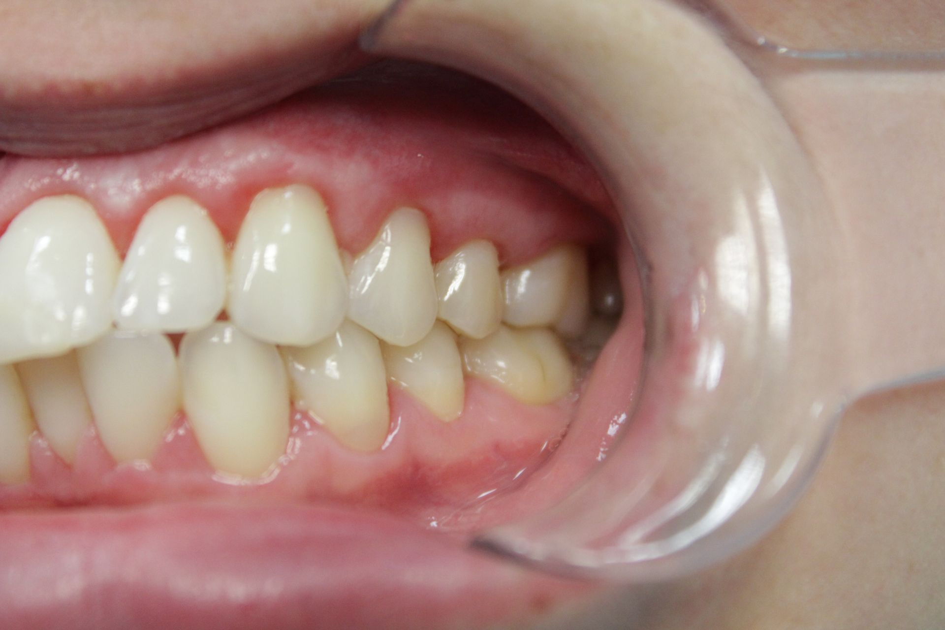 A close up of a person 's teeth with a mouth guard.