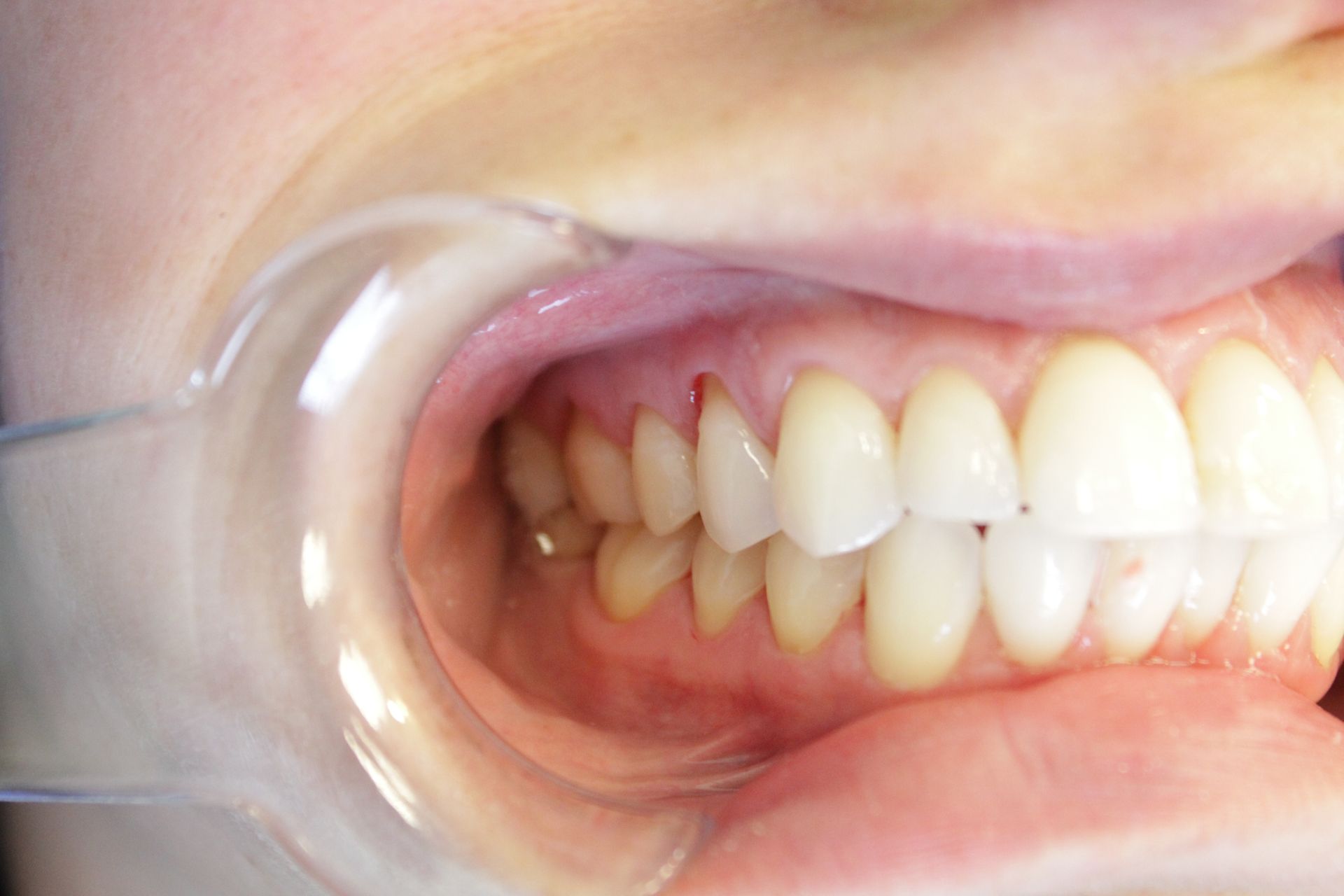 A close up of a person 's teeth with a mouth guard.