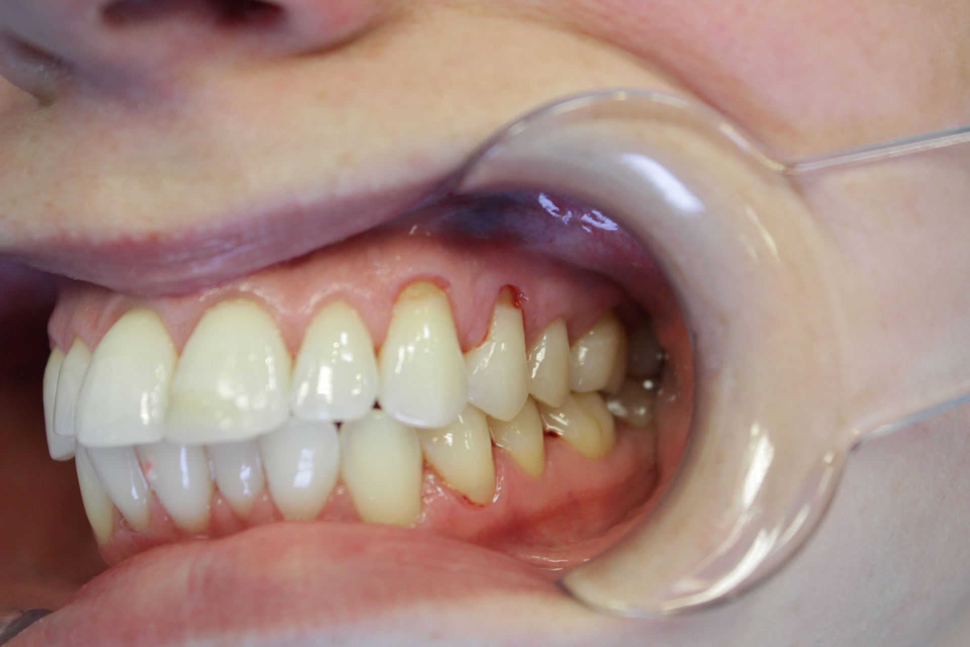 A close up of a person 's teeth with a mouth guard.