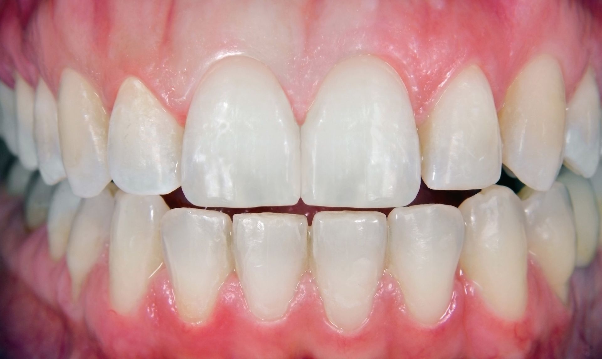 A close up of a person 's teeth with white teeth.