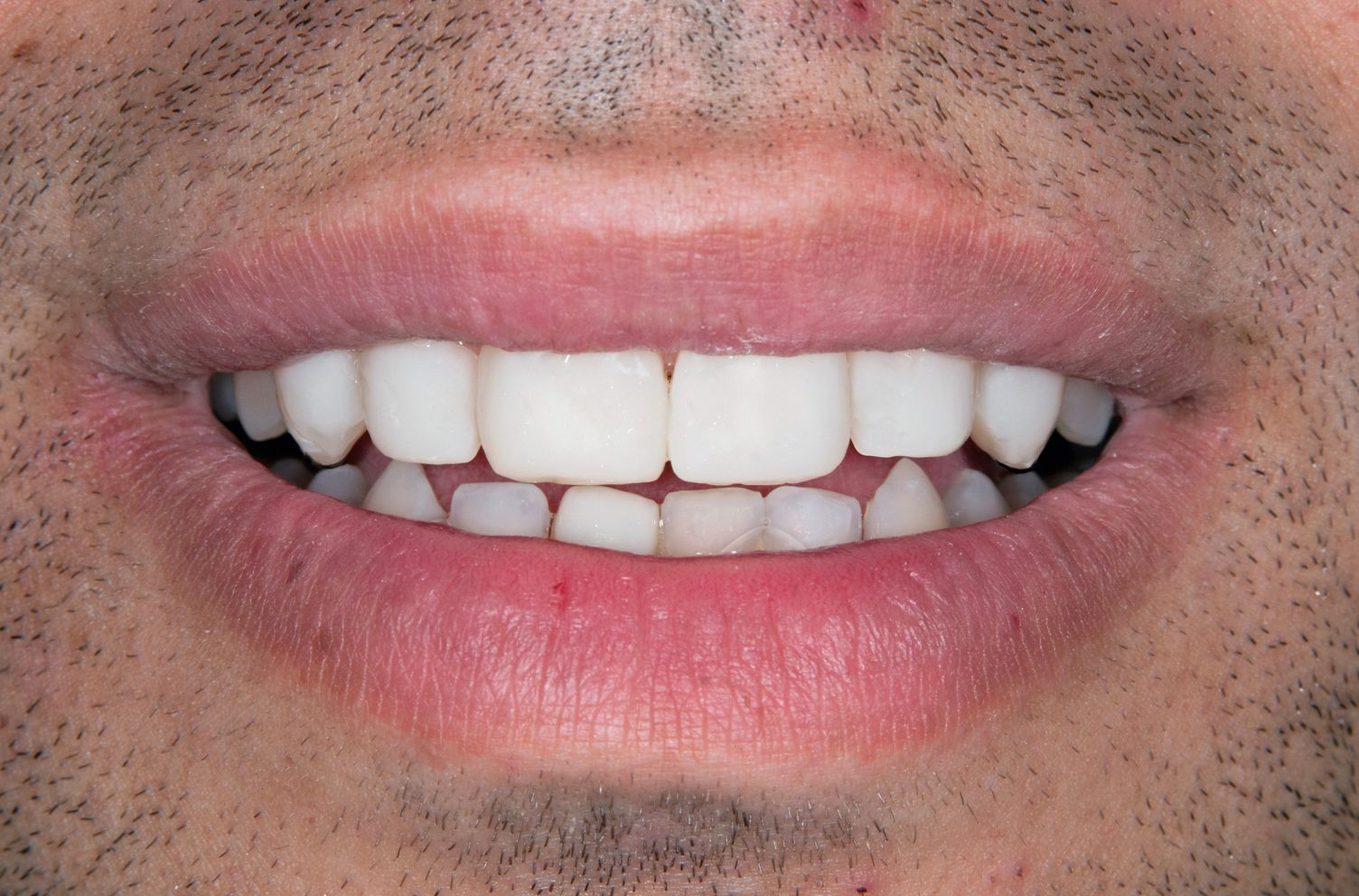 A close up of a man 's mouth with white teeth.