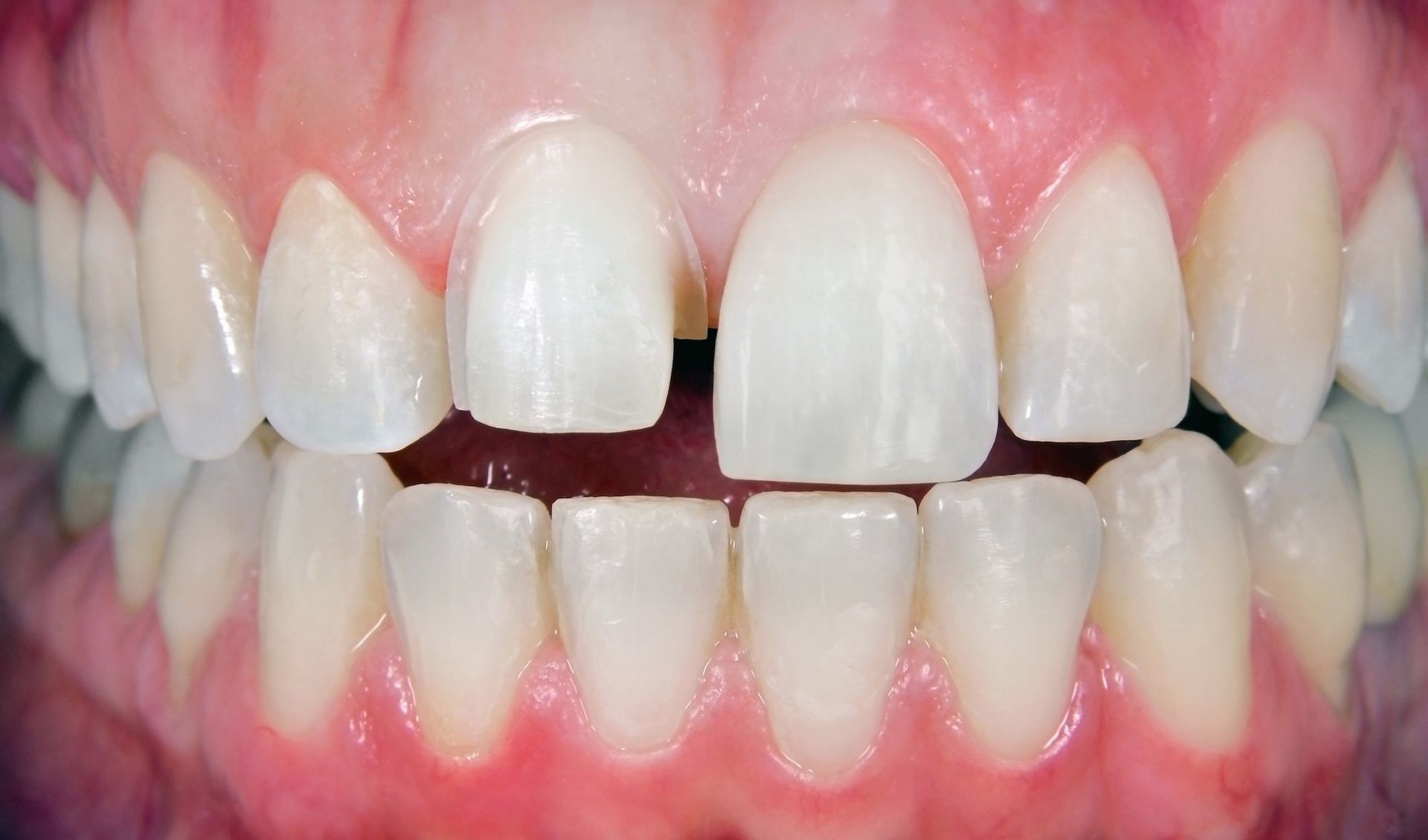 A close up of a person 's teeth with a missing tooth.