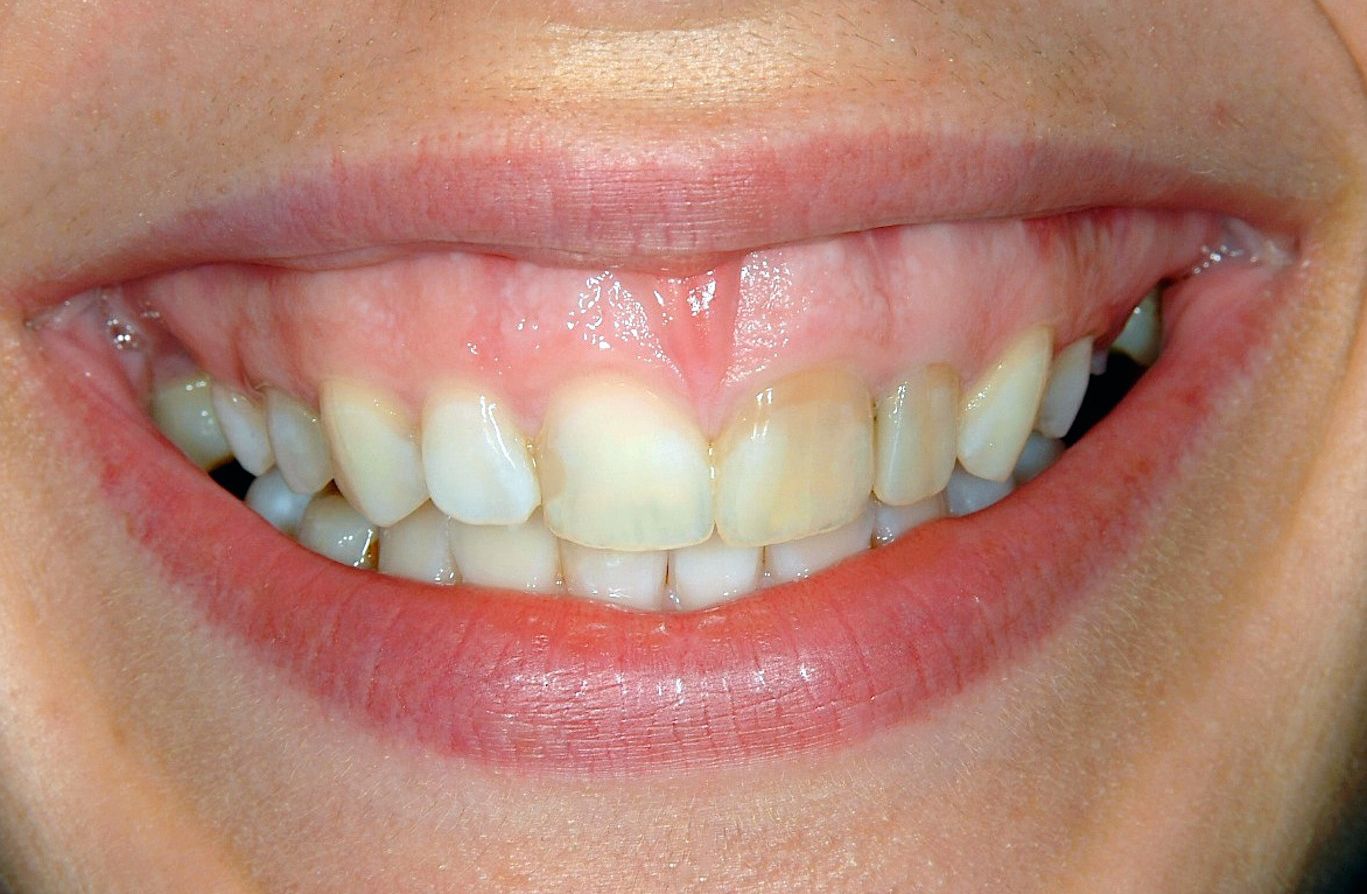 A close up of a woman 's mouth with white teeth and red lips.