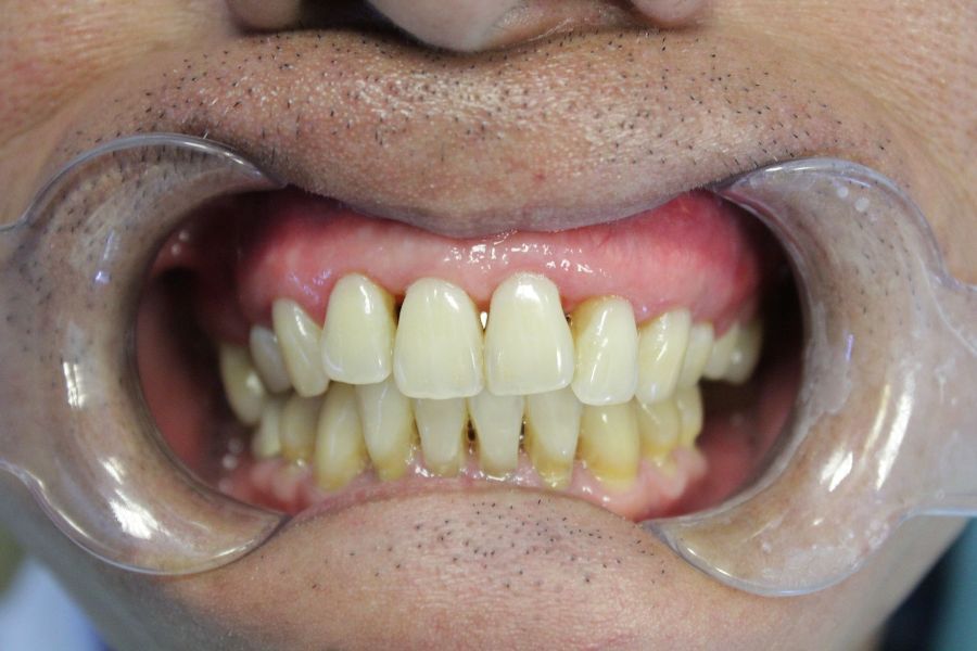 A close up of a man 's mouth with braces on his teeth.