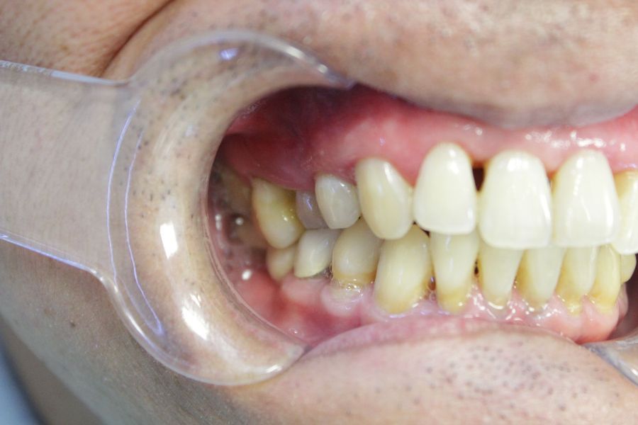 A close up of a person 's teeth with a mouth guard.