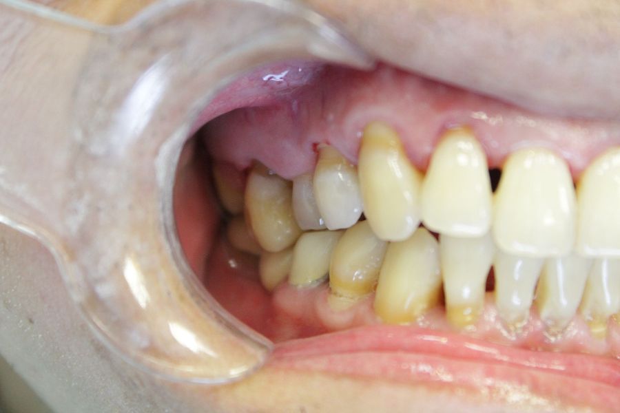 A close up of a person 's teeth with a clear mouth guard.