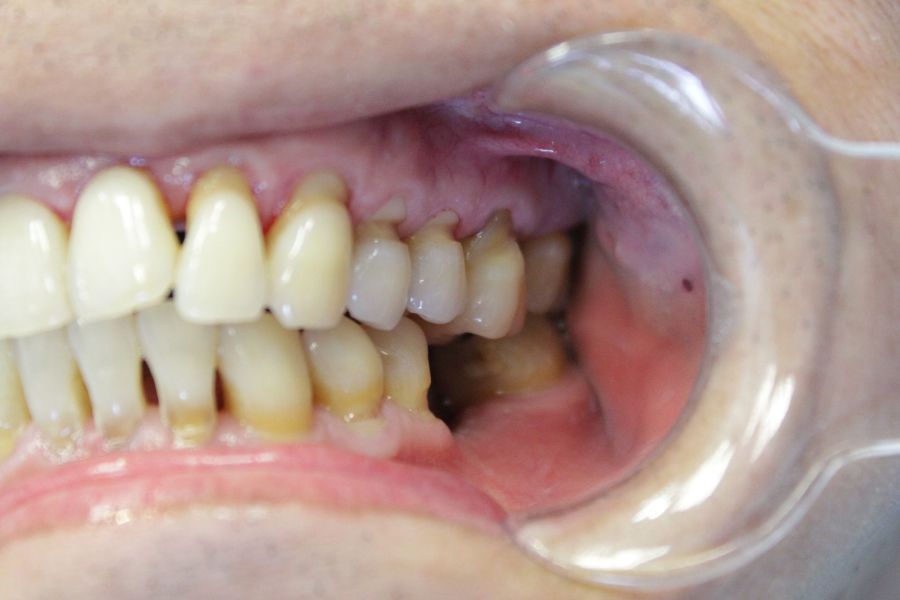 A close up of a person 's teeth with a mouth guard.