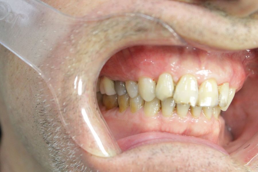 A close up of a man 's teeth with a plastic mouth guard.