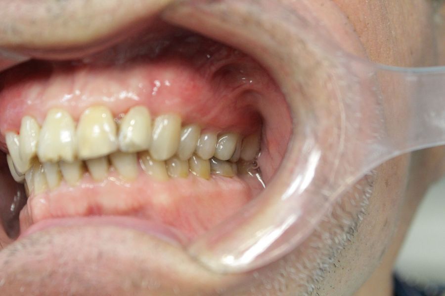 A close up of a man 's mouth with a plastic mouth guard.