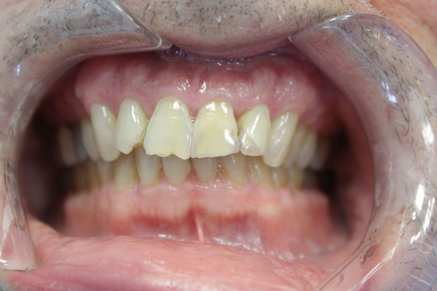 A close up of a person 's teeth with a clear mouth guard.