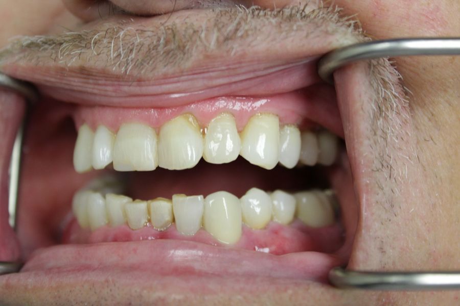 A close up of a man 's teeth with braces.