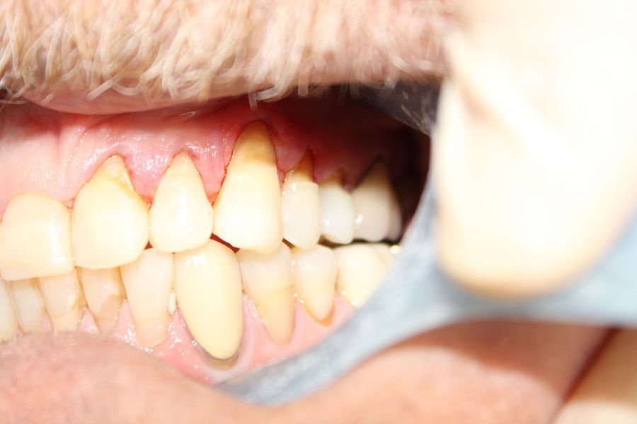 A close up of a person 's teeth with a dental mirror.